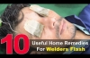 Top 10 Home Remedies To Treat Welder's Flash - Eye Pain Home Remedies
