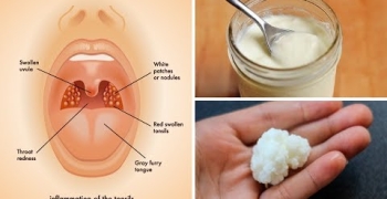 3 Powerful Home Remedies for Tonsil Stones That Work Fast! (Tonsilloliths)