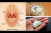 3 Powerful Home Remedies for Tonsil Stones That Work Fast! (Tonsilloliths)