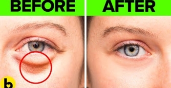 17 Easy Home Remedies To Get Rid Of Under Eye Bags