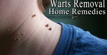 Warts - 5 Simple Home Remedies to Get Rid of Facial Warts Naturally 