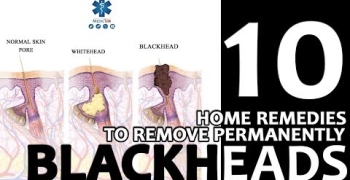 BLACKHEADS: 10 Best Home Remedies to remove it relying on Science