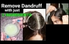 Magical Home Remedy to Remove DANDRUFF at home//Dandruff treatment/How to get rid of dandruff